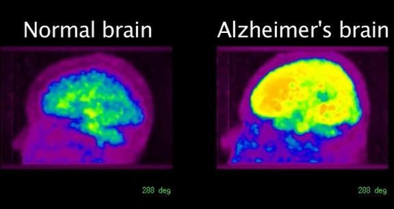 Vi kan i dag identifisere hjernestress hos Alzheimerpasienter gjennom PET-skanning.