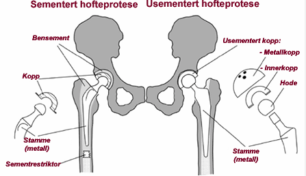 Figur 5: Illustrasjon av sementert og usementert hofteprotese (NRL 2015a) Hemiprotese, hvor bare stamme med hode i femur settes inn, benyttes oftest ved hoftebrudd som vanligvis er