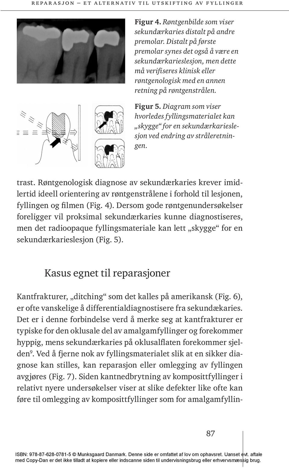 Diagram som viser hvorledes fyllingsmaterialet kan skygge for en sekundærkarieslesjon ved endring av stråleretningen. trast.