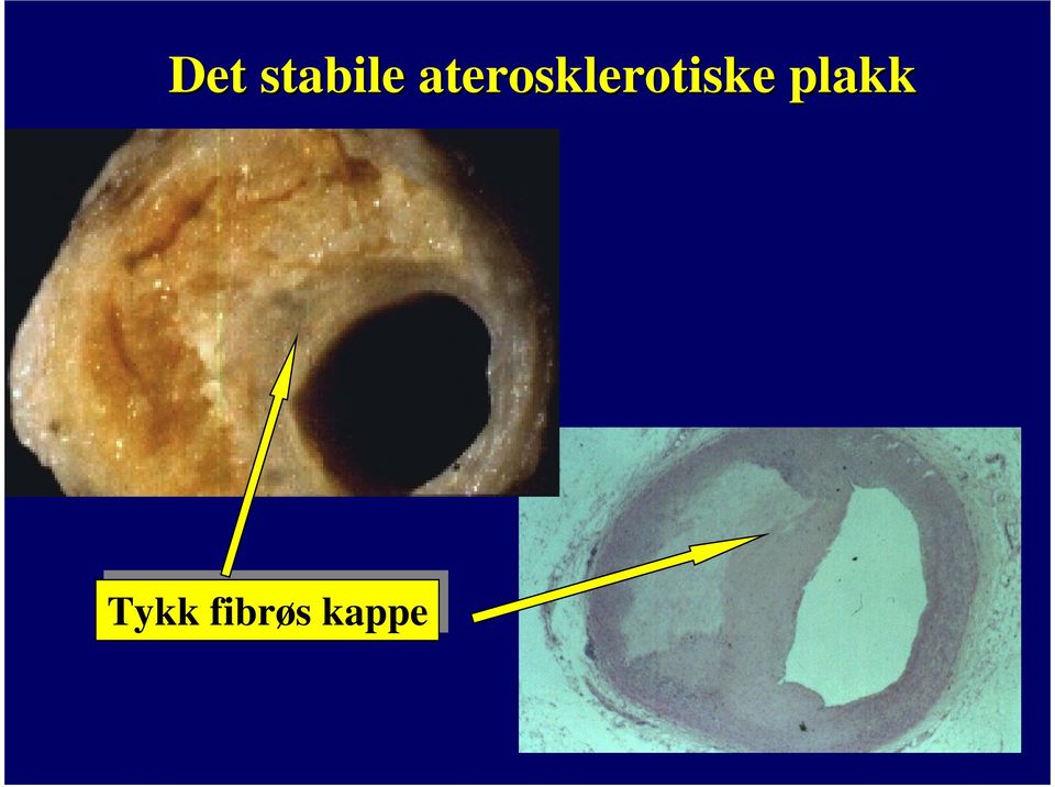 plakk Tykk fibrøs