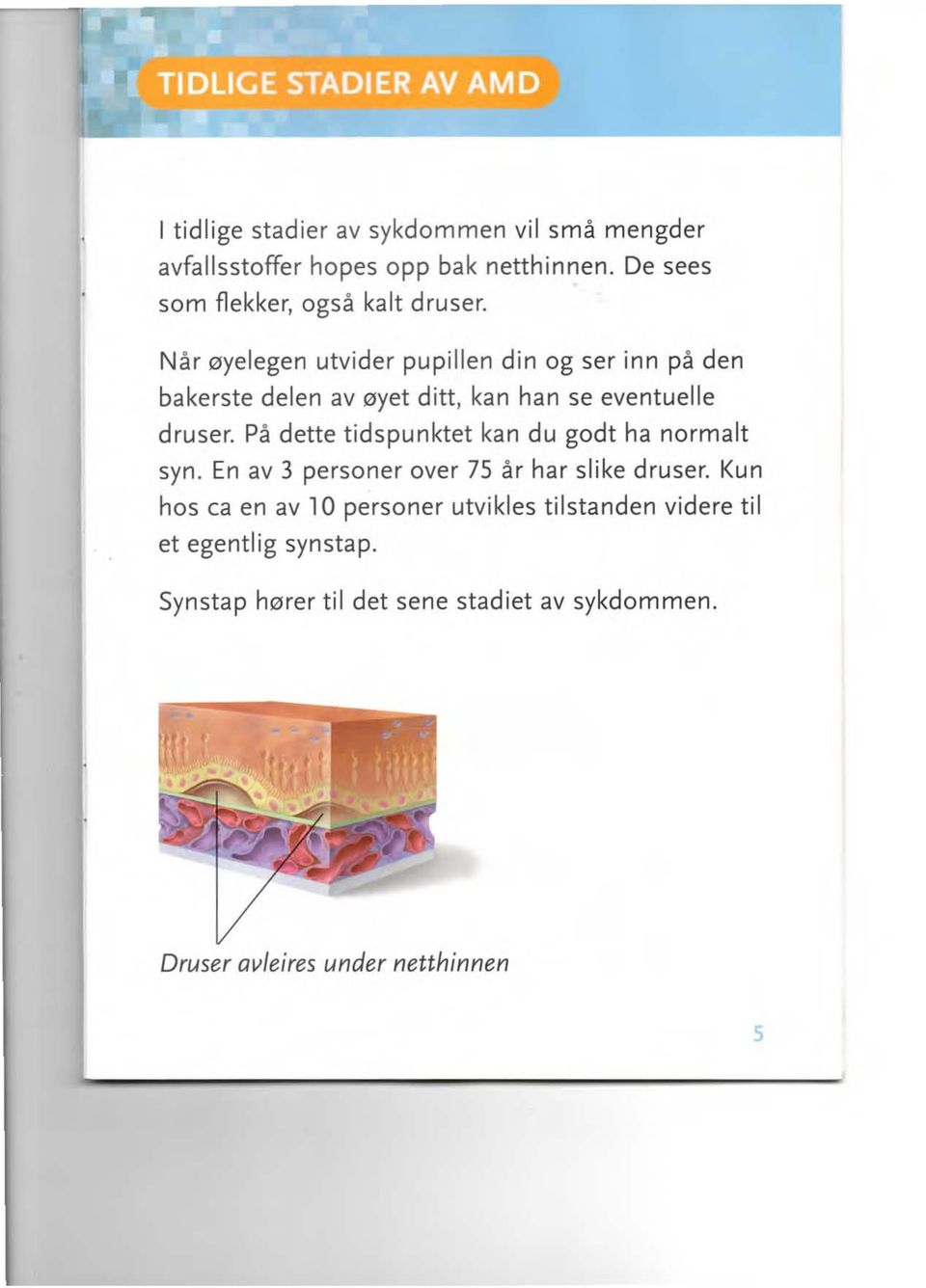 Når øyelegen utvider pupillen din og ser inn på den bakerste delen av øyet ditt, kan han se eventuelle druser.