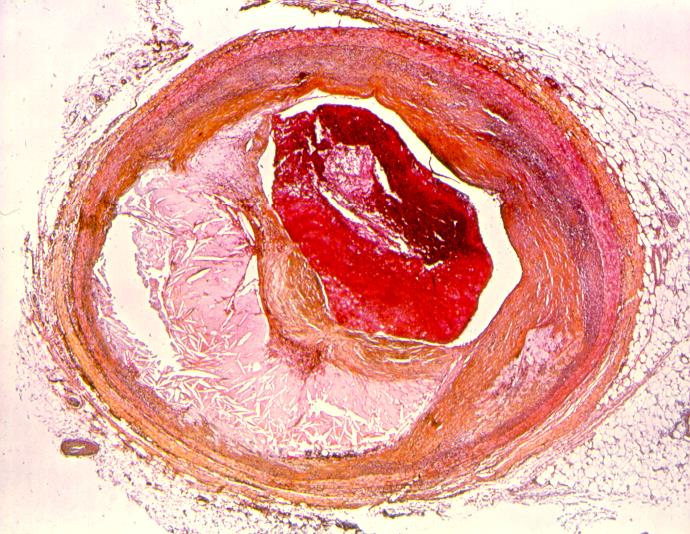 Plakkruptur -mye kolesterol -Mye betennelsesceller -tynn kappe av bindevev -mye betennelsesceller - en tikkende bombe