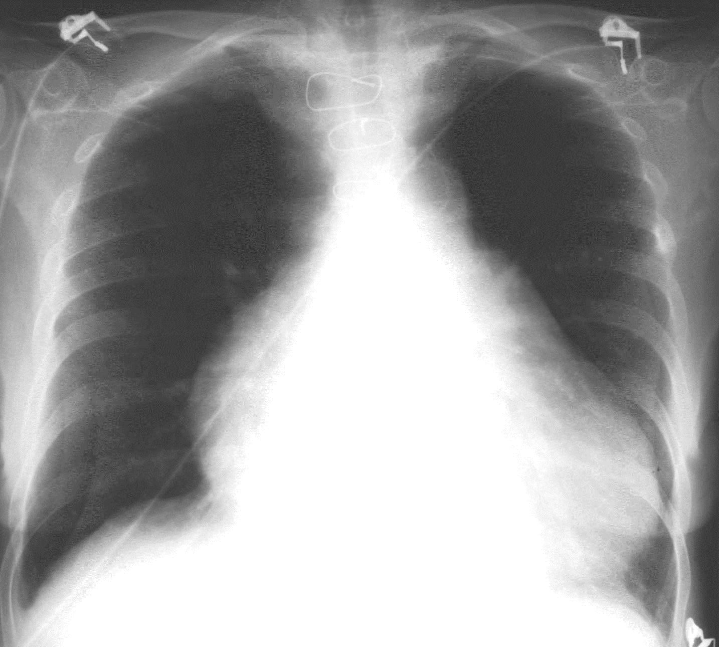 Bilateral pneumothorax er