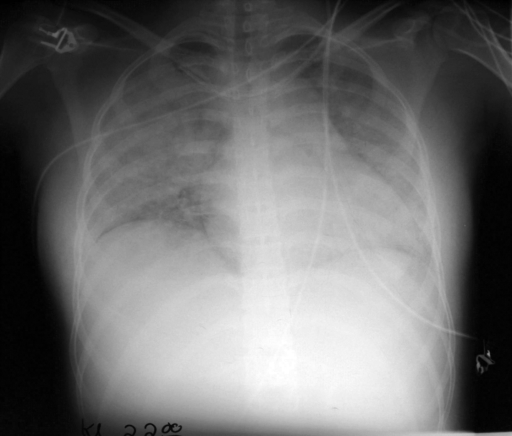 ARDS diffuse bilaterale