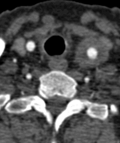 Aortitt Takayasu Akutt Fortykket høyattenuerende aortavegg (Senserie 7 min) Feber,