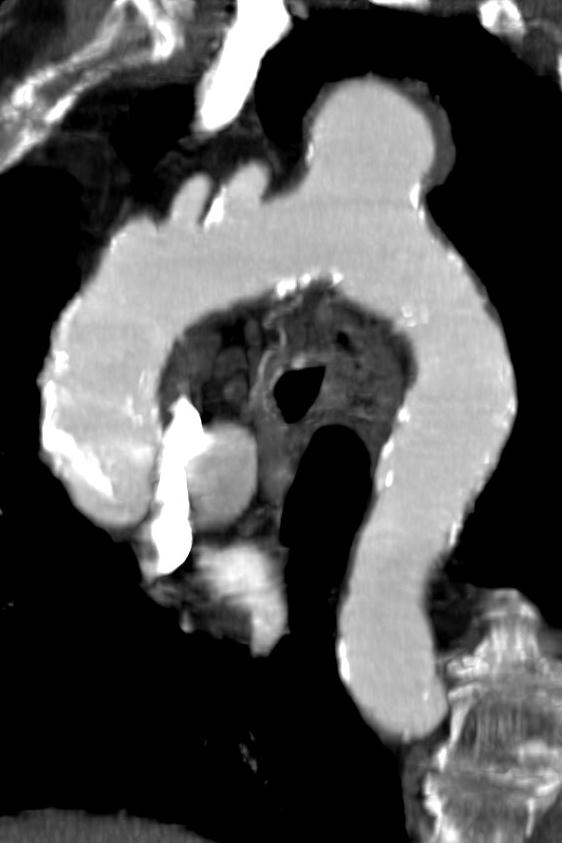 Stentgraft Preoperativt Grener Landing-zones Lumen-diameter Lengde