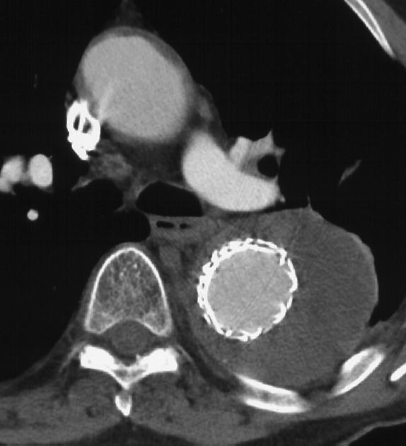 Stentgraft Kontroller Aneurisme