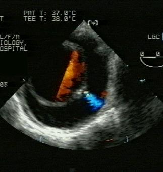 Transøsofageal ultralyd Ax.