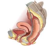 Behandling rectum prolaps Ventral