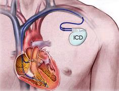 Devices Implantable cardioverter defibrillator (ICD) Approx.