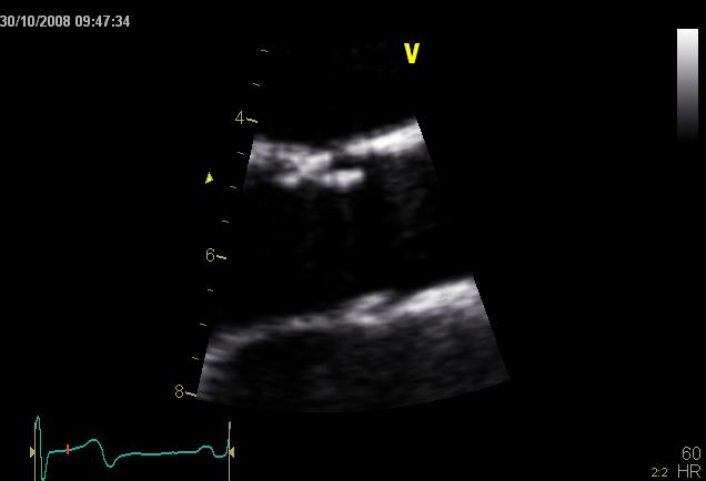 Minuttvolum ved Doppler LVOT areal MÅLESTED aorta annulus = LVOT = venstre utløp - parasternal langakse - veldefinert diameter D A -