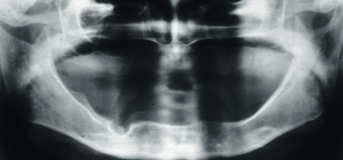 Figur 4. OPG av tannløs pasient. Bildet gir oversikt over beinforholdene i underkjeven og, noe mer diffust, i overkjeven.