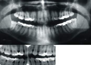 Figur 6. OPG og to bitewings fra samme pasient. OPG-bildet har god kvalitet sammenlignet med tilsvarende bilde i Figur.