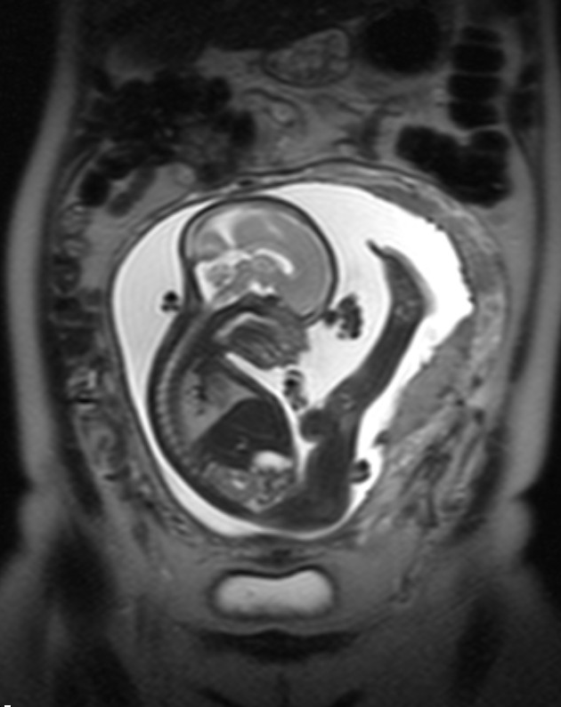 også intrauterint.