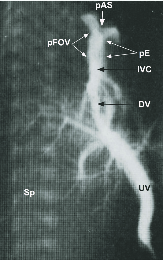 Figur 3: a) Sagittalt snitt viser bare øvre delen av vena cava inferior (IVC) der den har utvidet seg mot venstre og mottar oksygenert blod fra umbilikalvenene (UV) via shunten ductus venosus (DV).