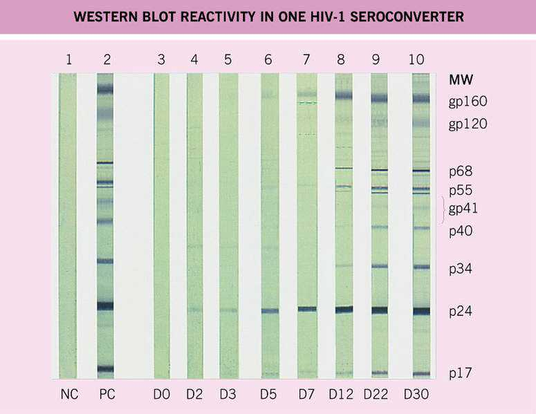 HIV-1 WESTERN BLOT (WB) Båndmønsteret kan variere mellom ulike WB-tester blant annet på grunn av variasjoner i grad av denaturering av virusproteinene under framstillingen av reagensene.