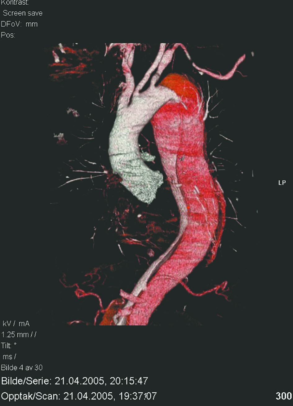 Figur 3: CTA med 3-D rekonstruksjon (Radiologisk avdeling, OUS, Rikshospitalet).