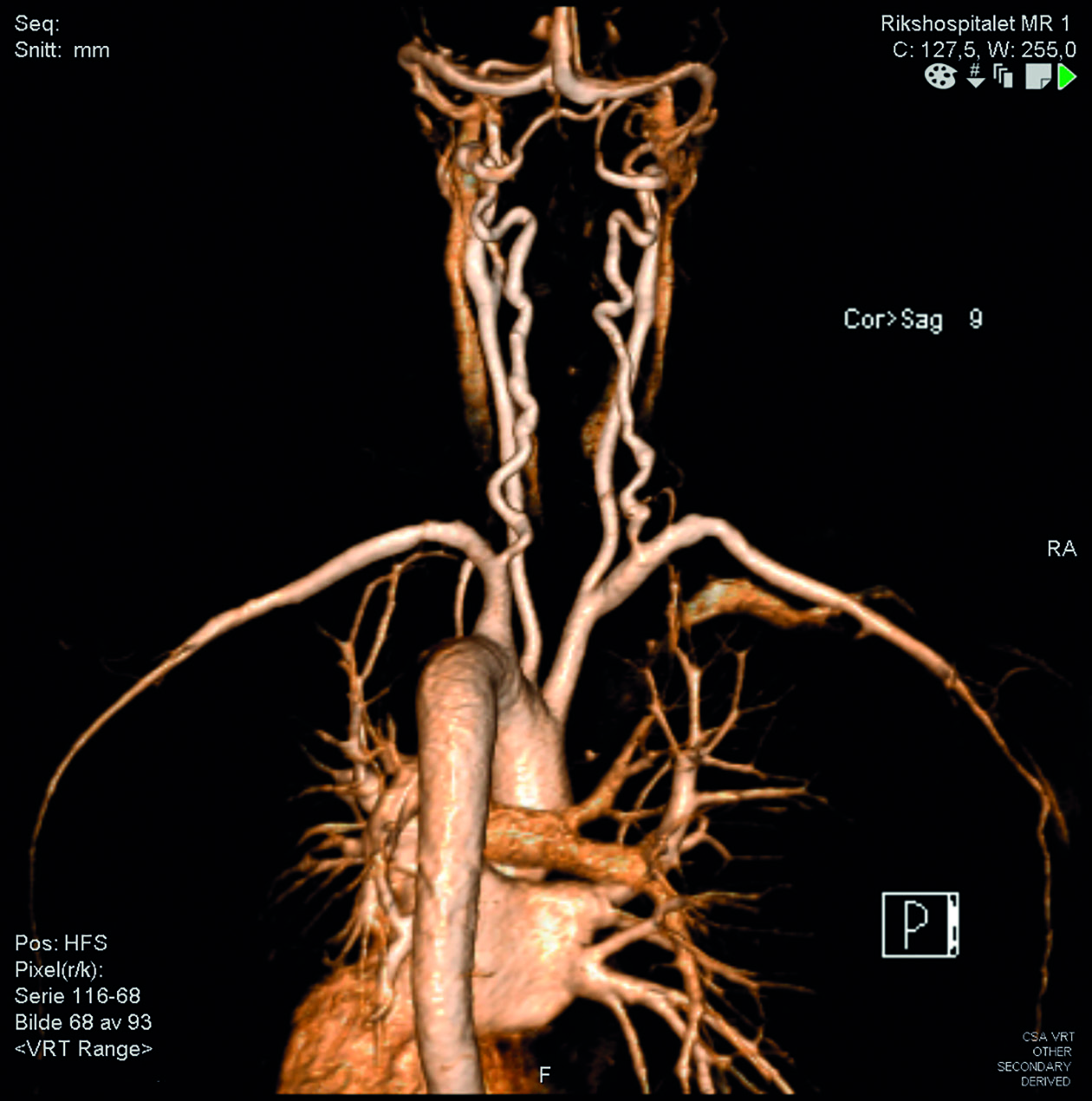 Figur 4: MRA med 3-D rekonstruksjon (Radiologisk avdeling, OUS, Rikshospitalet). «Vertebral artery tortuosity» hos pasient med Loeys-Dietz syndrom. Slyngede, elongerte aa.