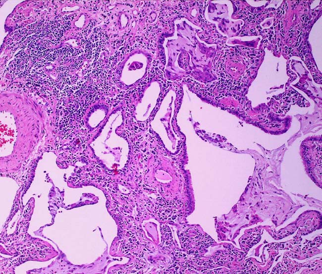 Mønster 2: Fibrose Med isolert honeycomb (obs fokal