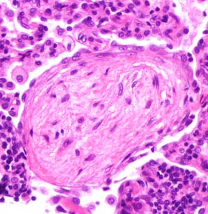 Mønster 4: Alveolar Filling Med organiserende pneumoni