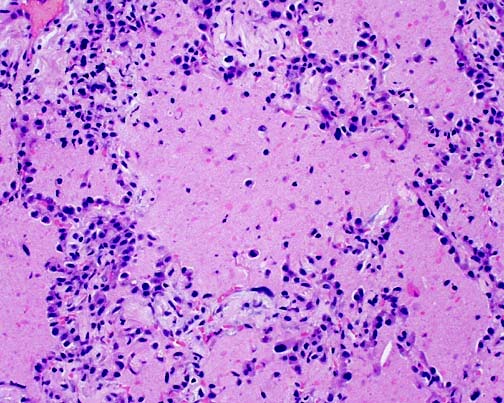 Mønster 4: Alveolar Filling Med eosinofilt materiale Ødem: Fibrin: Infeksjon, revma., syndr.