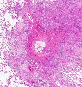 Mønster 5: Noduli Med organizing pneumonia Infeksjoner