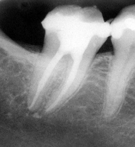 Behandling av apikal periodontitt: Er dette tilheling på grunn av, eller på tross av, rotfyllingsmaterialet og overskudd? Se og tenk selv?