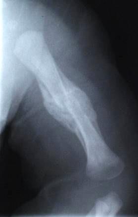 Bruddkallus, et eksempel Nydannet ben i kallus, mekanisk svakt