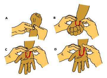 Allens test Hold hånden høyt, knyc hånden Komprimer både radialis og ulnaris Senk hånden og