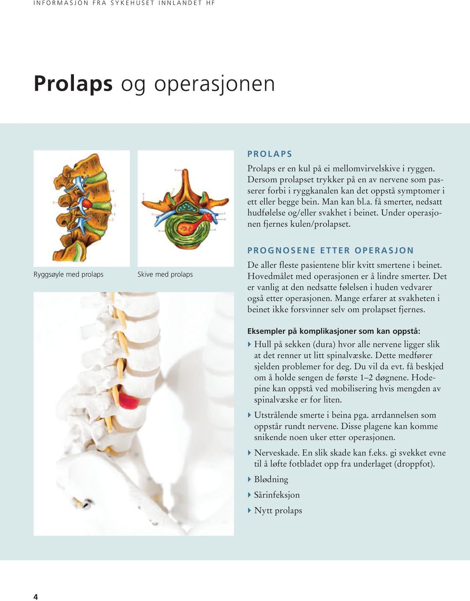 Under operasjonen fjernes kulen/prolapset. Ryggsøyle med prolaps Skive med prolaps P R O G N O S E N E E T T E R O P E R A S J O N De aller fleste pasientene blir kvitt smertene i beinet.