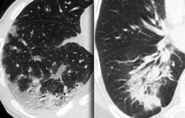 KRYPTOGEN ORGANISERENDE PNEUMONI HRCT: Konsolidering bilateralt, perifert I