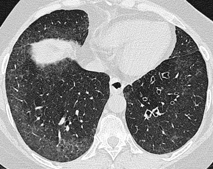 RHEUMATOID ARTRITT