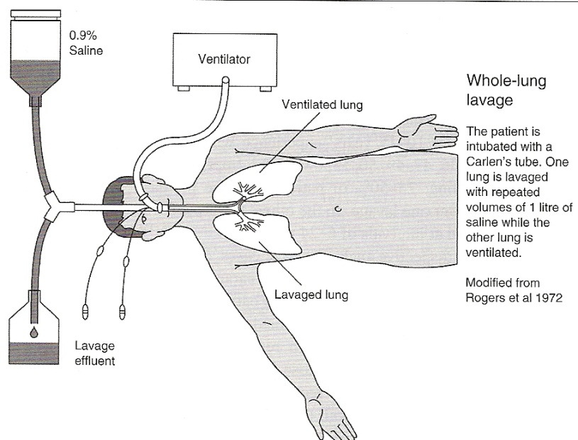 ALVEOLÆR PROTEINOSE Behandling: hellunge-lavage Fra Costabel: Diffuse Parenchimal Lung Disease