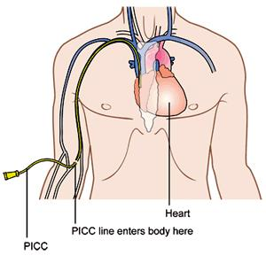 Catheter placements
