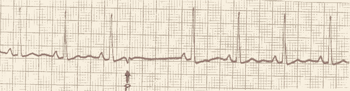 Blokkert atrial ekstrasystole Det kommer ikke noe QRS-kompleks