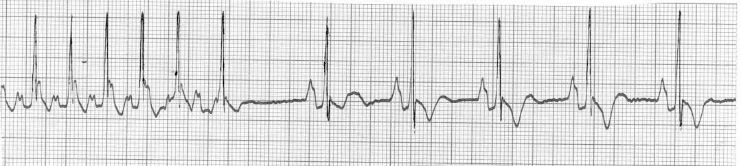 Atrieflimmer Atrieflimmer SVT