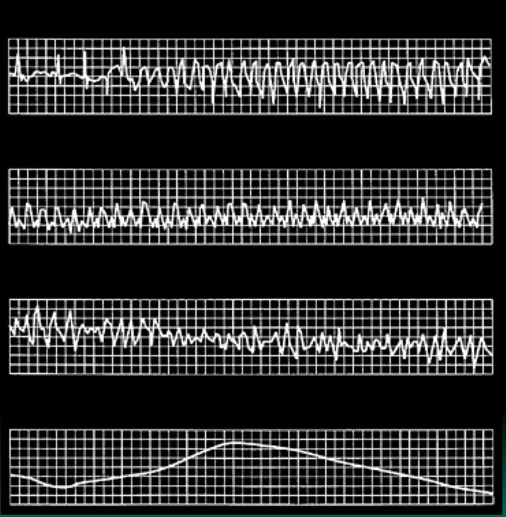 Rhythm Strip During Episode of Sudden Death 6:02 AM