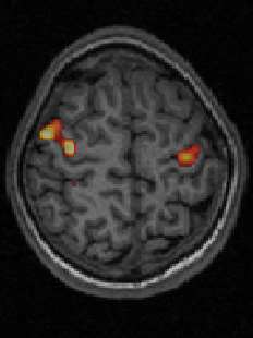 Diffusion Tensor Imaging Modellering av kontrastmiddeleffekt: K ps (permeabilitet) t ps ( t ) t R1/ 2 C( t) K C0 e d BV C0 e 0 Mars 2006 FYS-KJM 4740 68 Funksjonell (dynamisk)