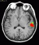 Funksjonell MR Flerdimensjonale bilder Funksjonell MR (f MRI) avbilder de delene av vevet hvor oksygenforbruket er høyt eller endres mens man gjør opptaket.