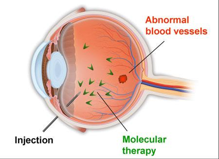 Medikamentinjeksjon ved AMD og diabetes retinopati Etter boområder (HF) 2011.