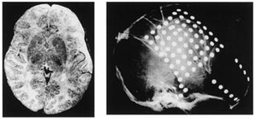 Elektrokliniske syndromer (2) Symptomatiske epilepsisyndromer Infantile spasmer (0-1 år) Lennox-Gastaut syndromet (> 1 år) Hypsarythmia (Delta aktivitet og mulifokale spikes) 1.