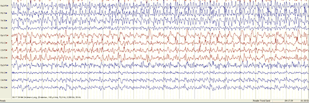 EEG-utredning Først: Vanlig EEG (60% treff; falske postive 1-2%) Deretter: Søvndeprivert EEG (80% treff; falske postive 8%) Hos et fåtall: 24 timers EEG (bærbar: mistanke om ESES) De færreste: