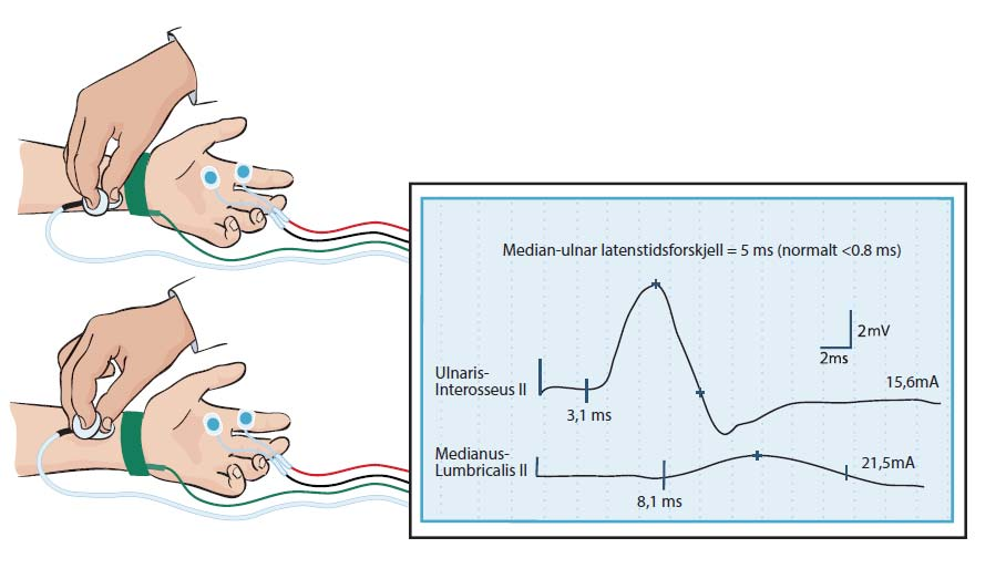 Medianusnerven og karpaltunnelsyndromet Langsom