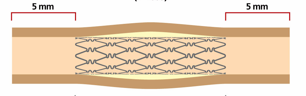 Innovativ teknologi Stent +