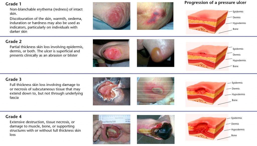 Trykksår klassifisering European