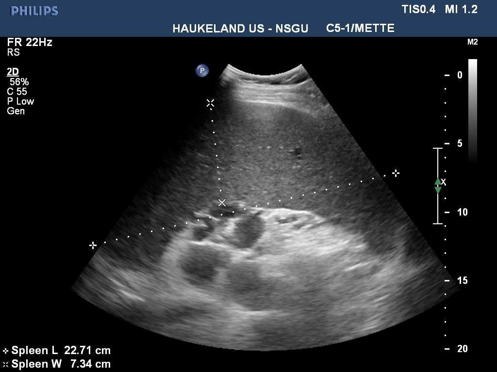 Vurdering av leverfibrose / cirrhose Forstørret lobus caudatus Ascites Dilatert v portae? Dopplerundersøkelse Mean velocity i vena porta Hastighetsprofil i v. hepatica V portae: Vanligvis < 1.