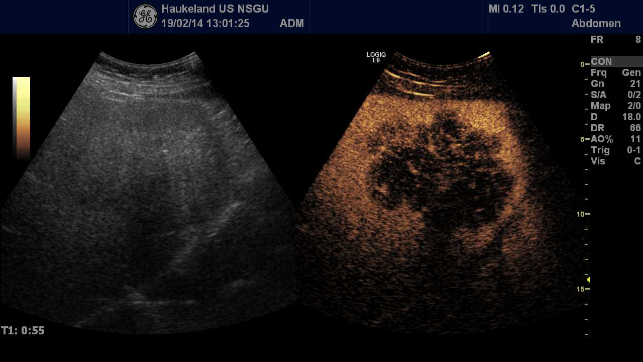 CCA Hyperenhanced in arterial phase CCA Hypoenhanced with rim-like hyperenhance.