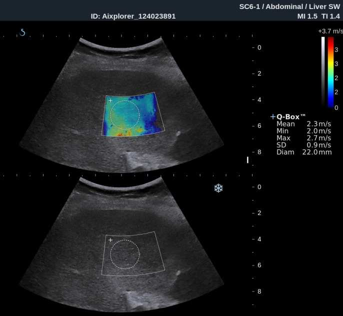 The future is ultrasonic! Elastografi - leverstivhetsmåling 1 2 1) Fibroscan 2) Real Time Tissue Elastogr.