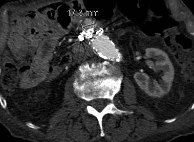 Kasus 1 CT kontroll 3 år og 9 mndr. postoperativt CT kontroll viste ytterligere vekst av aneurismesekken til 77 mm.