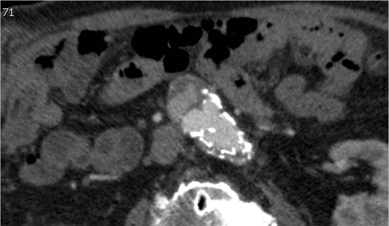 Kasus 1 CT kontroll 2 år og 6 mndr postoperativt Ny CT kontroll ble utført etter ulkontroll som viste diameterøkning fra 55 mm preoperativt til 60